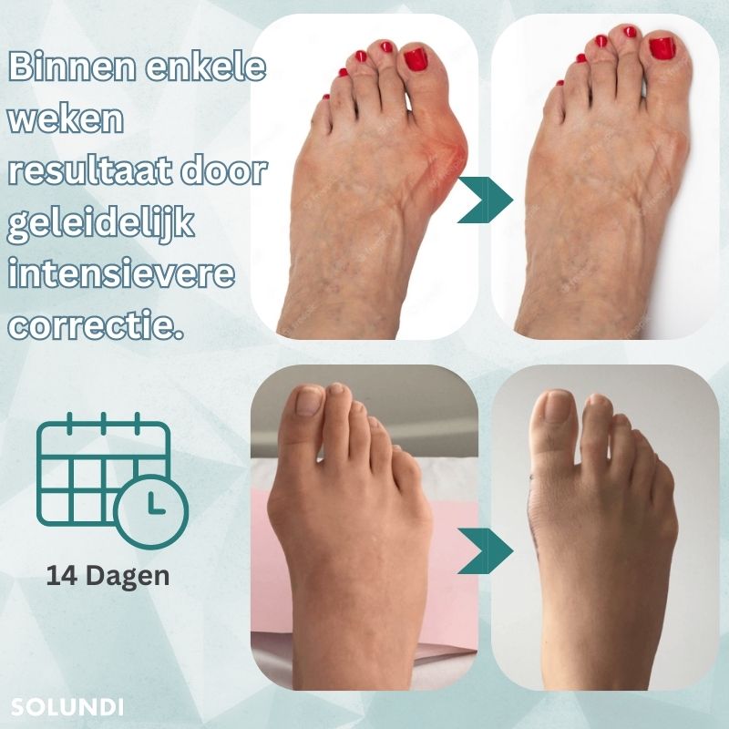 OrthoAlign™ – Grote teen Corrector