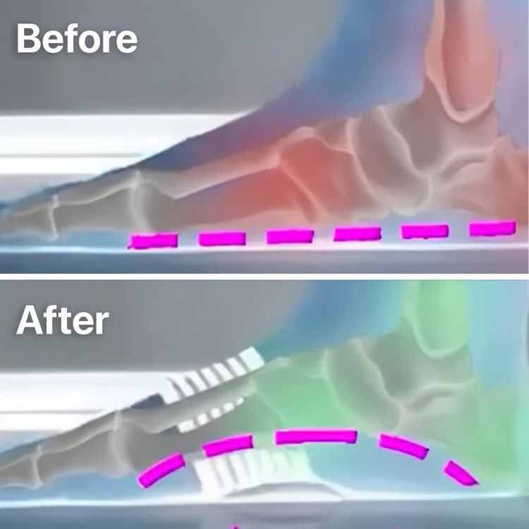 StepRelief™ | Orthopedische voetboogondersteuning