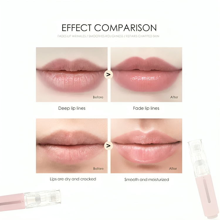 LipLift™ | Microneedle-lippenroller