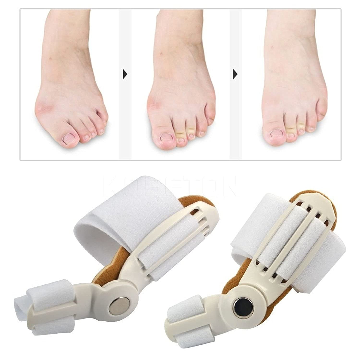 Toe Corrector™ - Orthopedische Bunion Toe Corrector